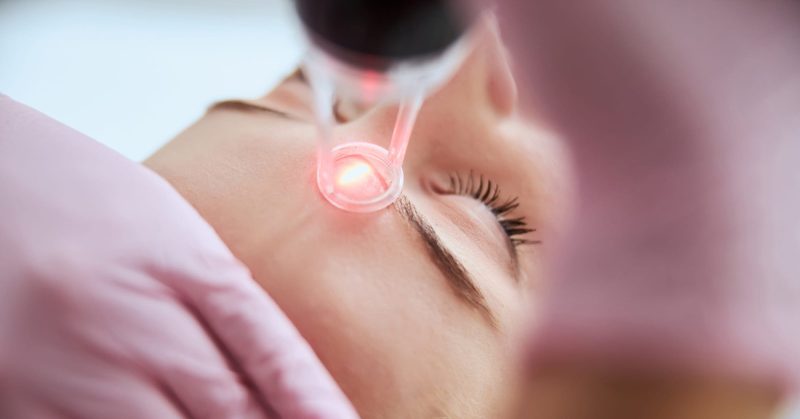 microneedling